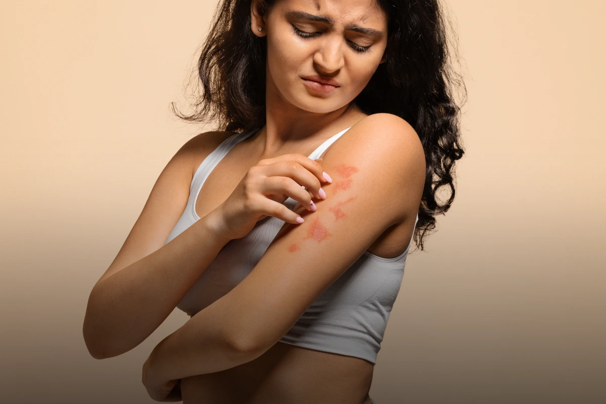 Psoriasis skin condition